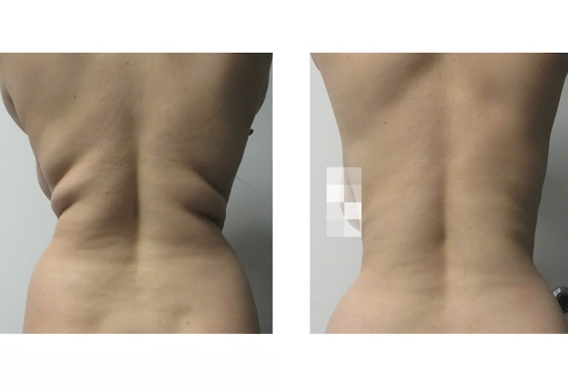 >Laser Fat Reduction